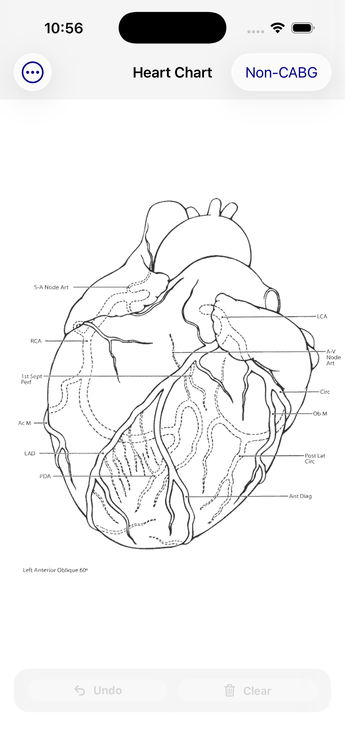 HeartChart app screenshot showing a heart diagram with graft drawing tools